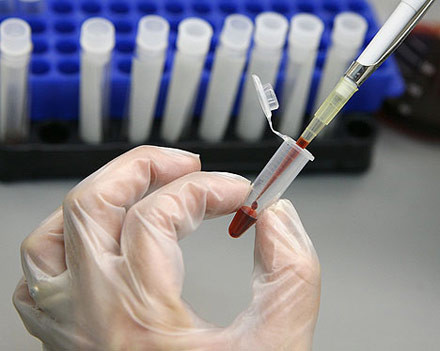 Νέα έρευνα: έλεγχος του καρκίνου του προστάτη με ένα απλό αιματολογικό τεστ