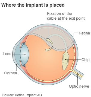 Τσιπ στο μάτι επιτρέπει στους τυφλούς να εντοπίζουν σχήματα και αντικείμενα