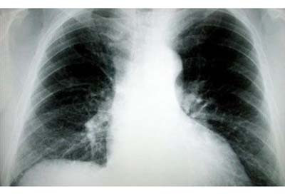 Πρώτη αιτία θανάτου παγκοσμίως, ο καρκίνος του πνεύμονα