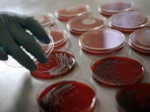 Στους 18 οι νεκροί από το βακτήριο E.coli