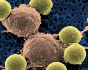 Ανακαλύφθηκε χημική ουσία που καταστρέφει καρκινικά κύτταρα της λευκαιμίας