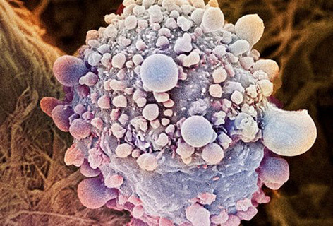 Γονίδιο επιβραδύνει την εξάπλωση καρκίνου του παγκρέατος