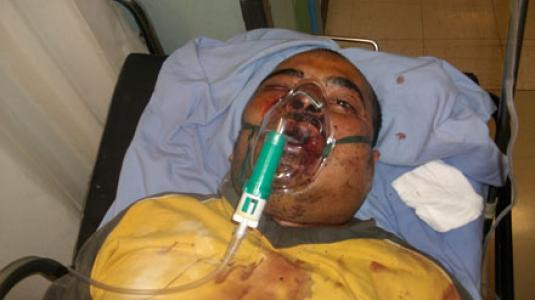 Με σοβαρά κατάγματα νοσηλεύεται ο 28χρονος Αιγύπτιος
