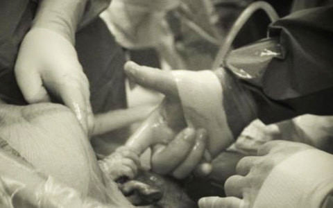 Αγέννητο μωράκι «αγκαλιάζει» το δάχτυλο του γιατρού που το φέρνει στον κόσμο