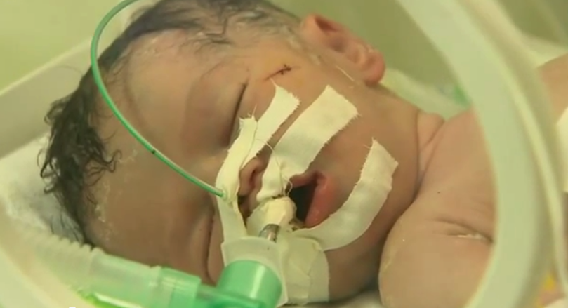 Πέθανε το μωρό που γεννήθηκε από το νεκρό σώμα της μητέρας του στη Γάζα
