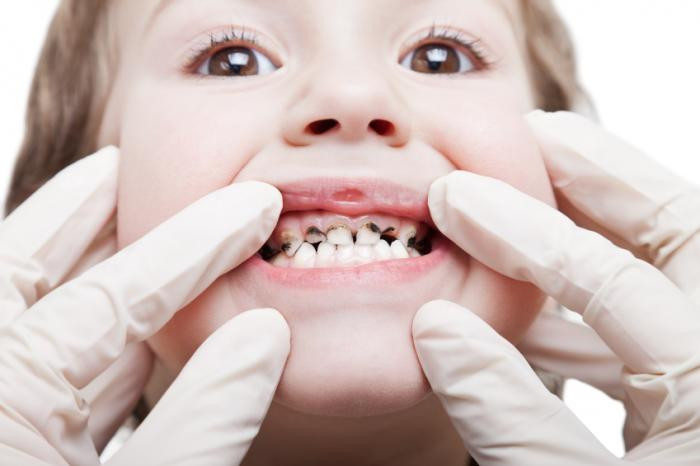 Το χρόνιο στρες της μητέρας συνδέεται με περισσότερα χαλασμένα δόντια στα παιδιά