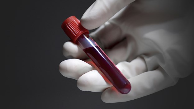 Πάρκινσον: Διάγνωση με ένα απλό τεστ αίματος