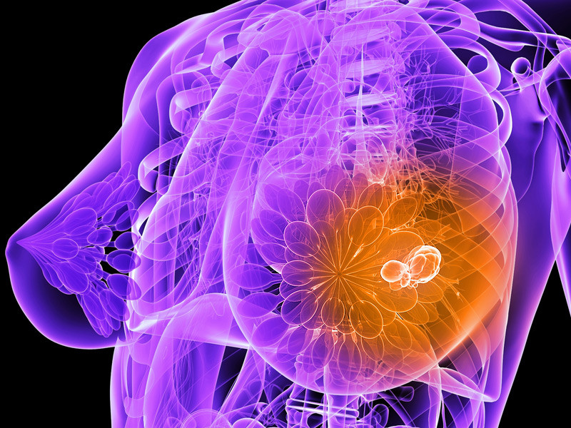 Η Google με τεχνητή νοημοσύνη θα εντοπίζει τον καρκίνο του μαστού!