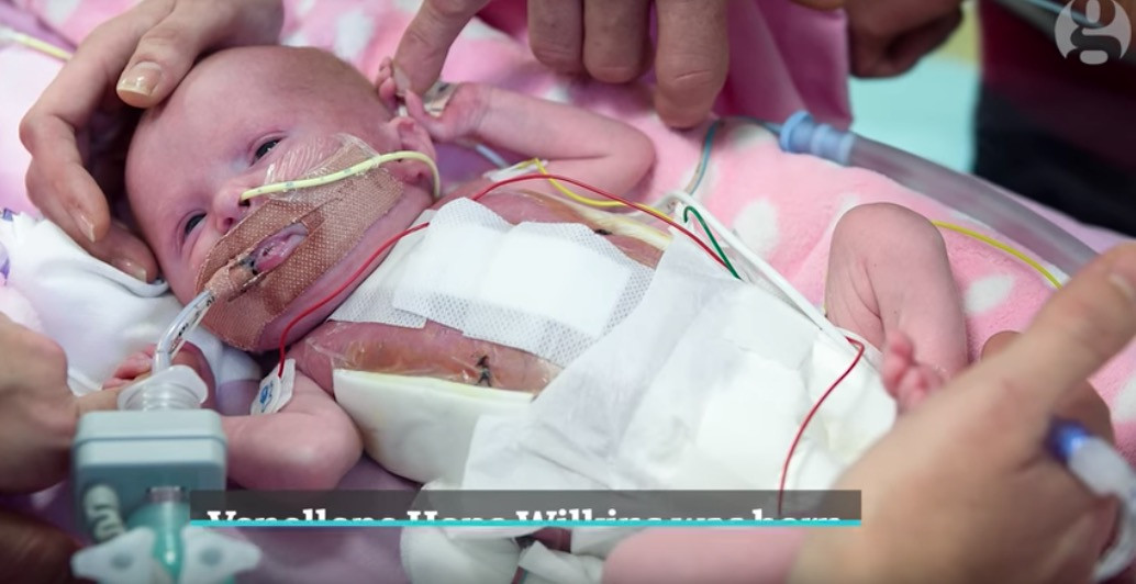 Κοριτσάκι γεννήθηκε με την καρδιά έξω από το σώμα του και επέζησε [Βίντεο]