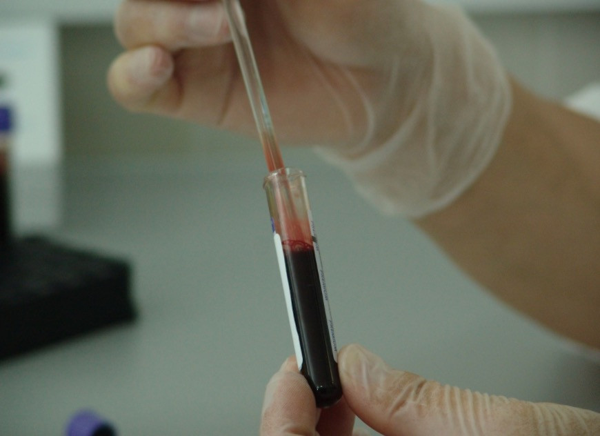 Το πρώτο τεστ αίματος που μπορεί να ανιχνεύσει οκτώ διαφορετικούς καρκίνους