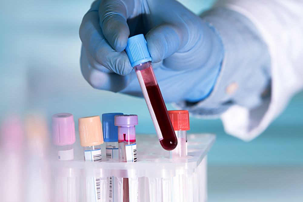 Τεστ αίματος υπόσχεται πρώιμη διάγνωση του μελανώματος