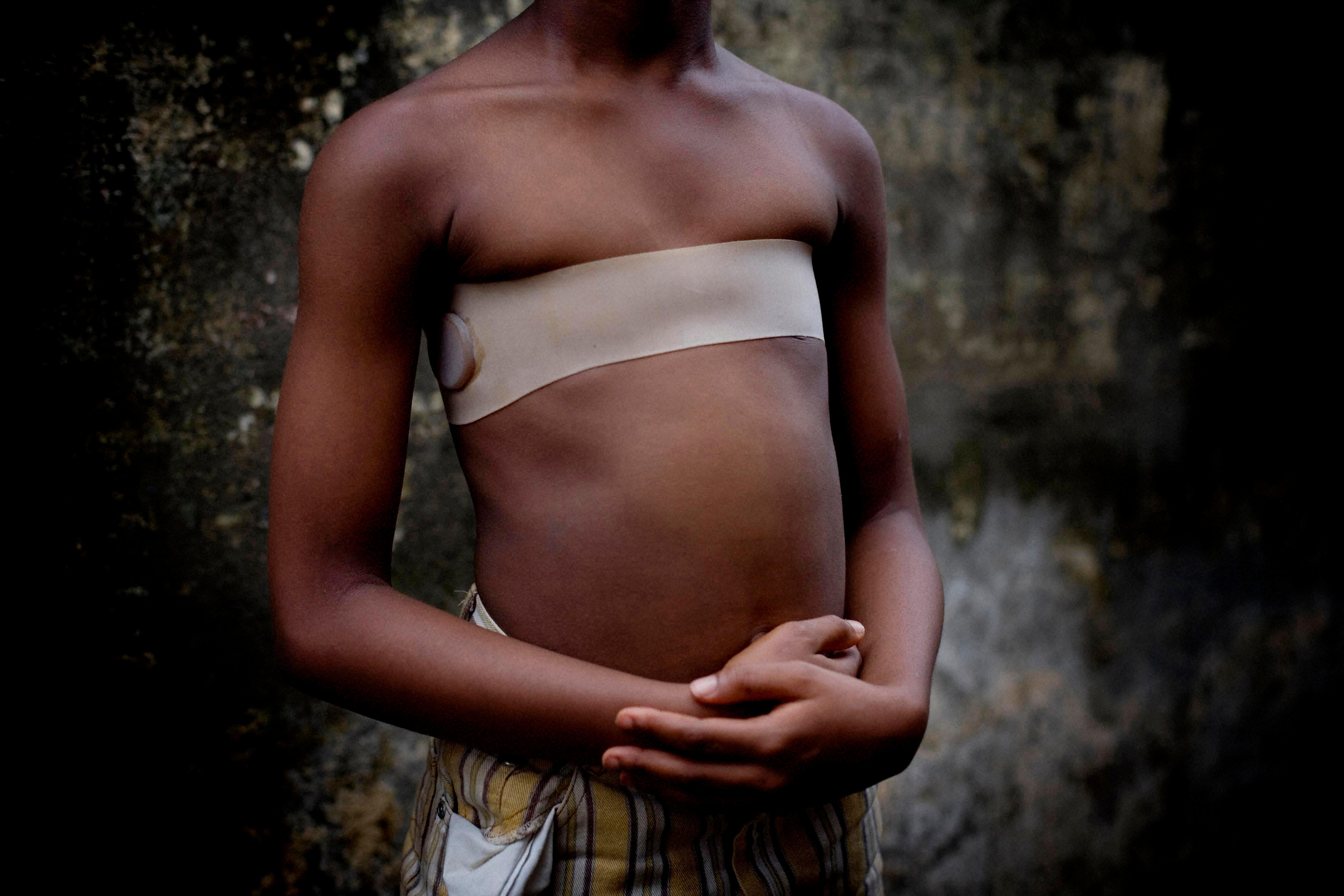 Σιδέρωμα στήθους: Μια φρικτή και απάνθρωπη πρακτική για μικρά κορίτσια