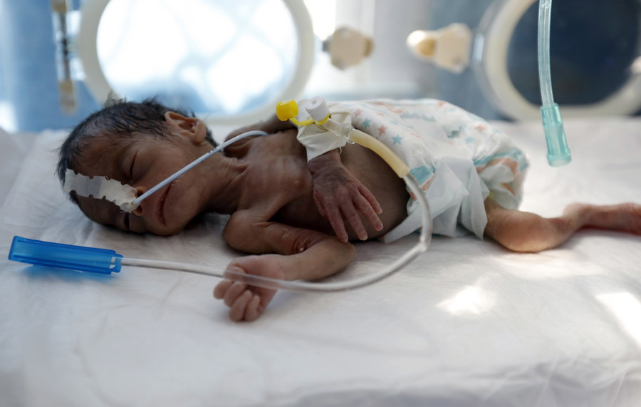 Πρωτόγνωρα επίπεδα υποσιτισμού στα παιδιά της Υεμένης