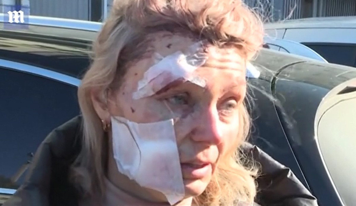 Εισβολή στην Ουκρανία: Τι λέει η τραυματισμένη γυναίκα που η φωτογραφία της έκανε τον γύρο του κόσμου
